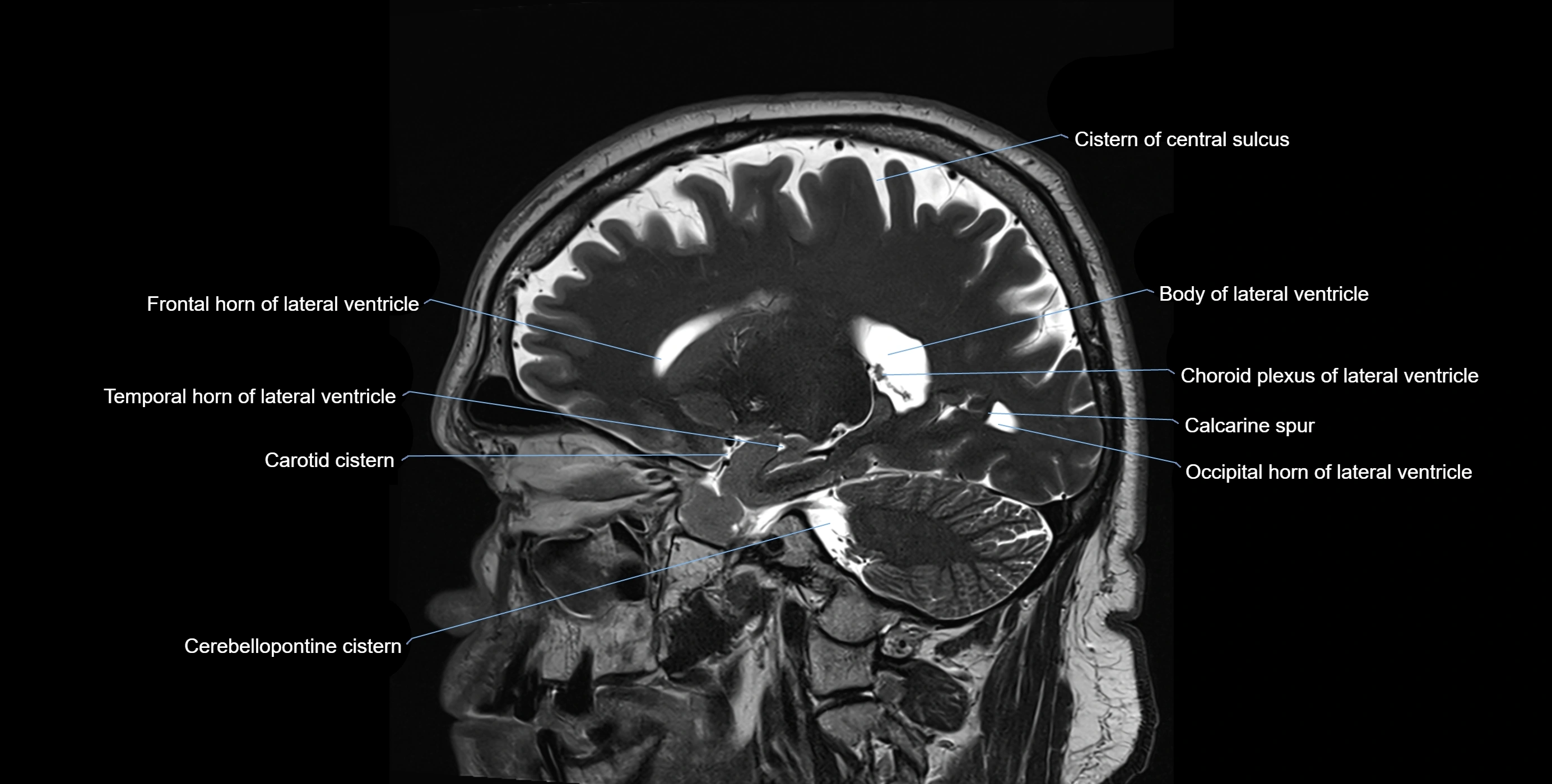 Brain cisterns  and ventricles sagittal anatomy 3T MRI image-img-00001-00020.webp